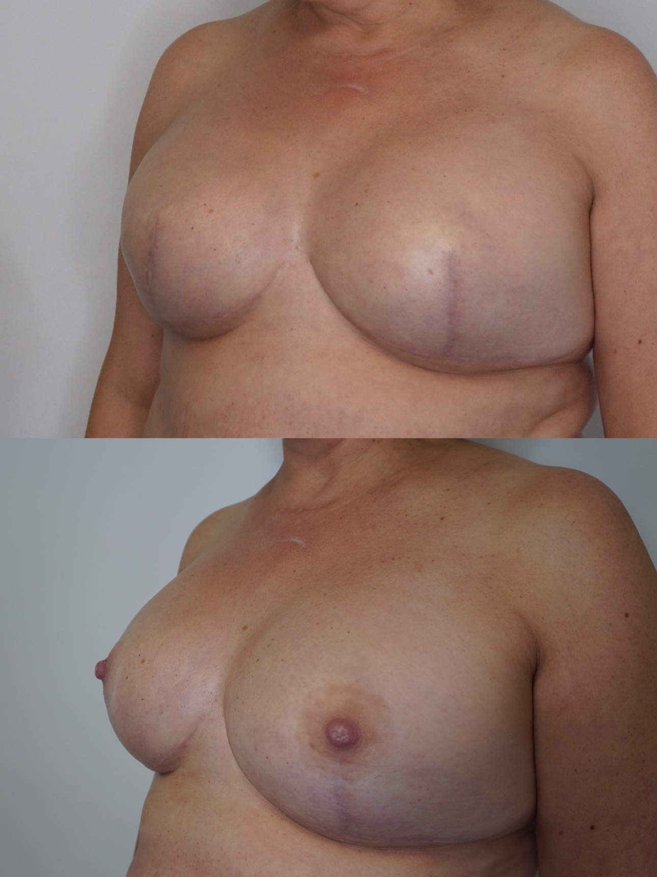 Antes y después de una reconstrucción bilateral: sin areolas ni pezones y con las dos prótesis colocadas